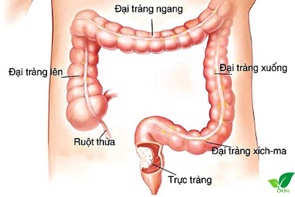 Ung thư trực tràng