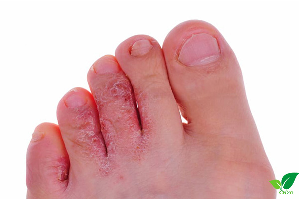 Hỗ trợ điều trị các bệnh ngoài da