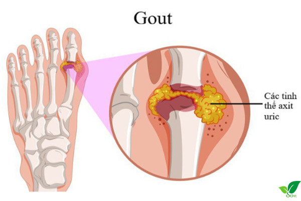 Bệnh gout là gì?